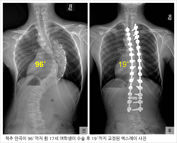 척추 만곡이 96°까지 휜 17세 여학생이 수술 후 19°까지 교정된 엑스레이 사진 