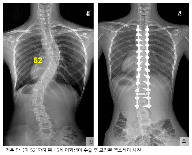 척추 만곡이 52°까지 휜 15세 여학생이 수술 후 교정된 엑스레이 사진