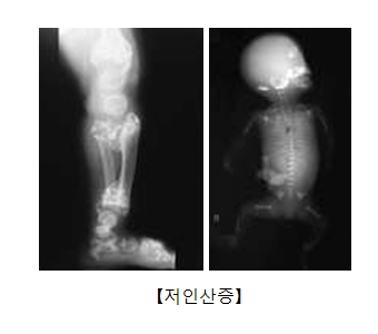 저인산증