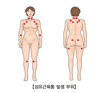 섬유근육통